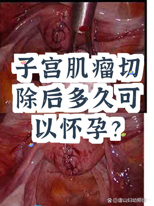 子宫肌瘤剔除后多久能怀孕