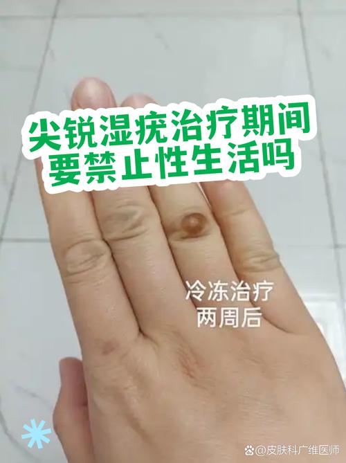 尖锐湿疣治疗期间要不要禁欲
