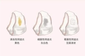 滴虫感染和细菌性阴道病怎么区分?一文教你轻松辨别!-两性知识丨两性健康--你想了解的我都知道