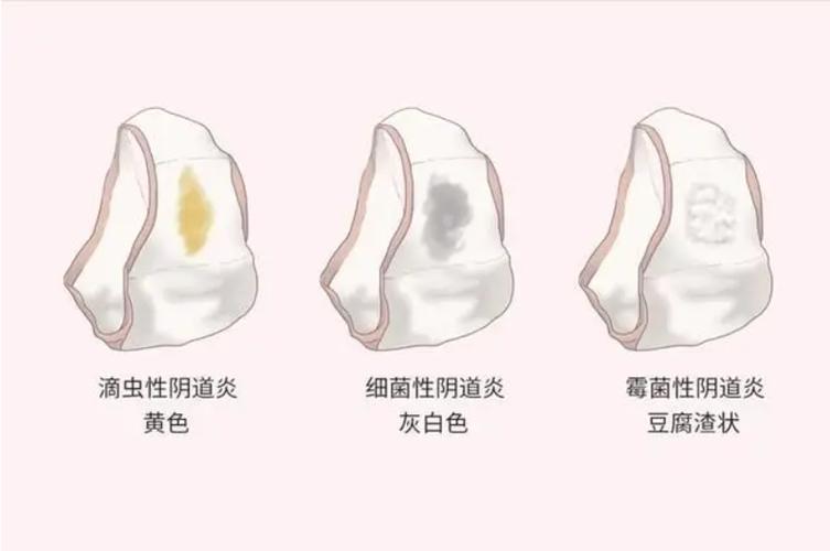 滴虫感染和细菌性阴道病怎么区分