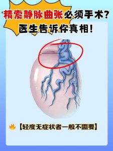 查出精索静脉曲张,到底要不要做手术?-两性知识丨两性健康--你想了解的我都知道