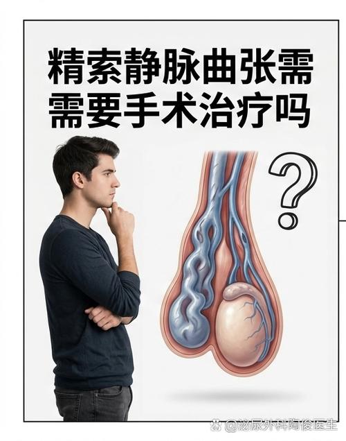 精索静脉曲张要不要做手术