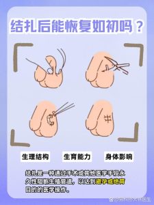 结扎后多久可以不用其他避孕-两性知识丨两性健康--你想了解的我都知道