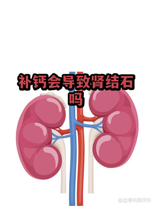 更年期补钙会得肾结石吗