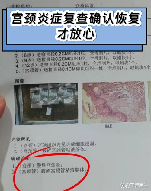 宫颈病变治疗后怎么复查