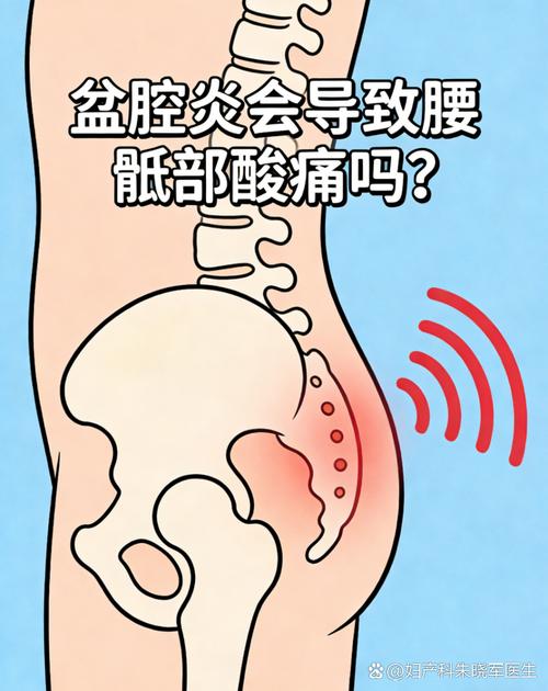 盆腔炎会引起长期腰酸吗