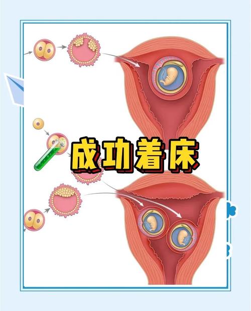 内异症会影响胚胎着床吗