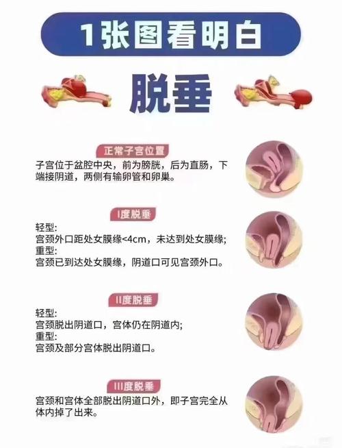 子宫脱垂的分度标准是什么