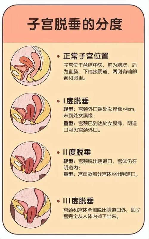 子宫脱垂的分度标准是什么