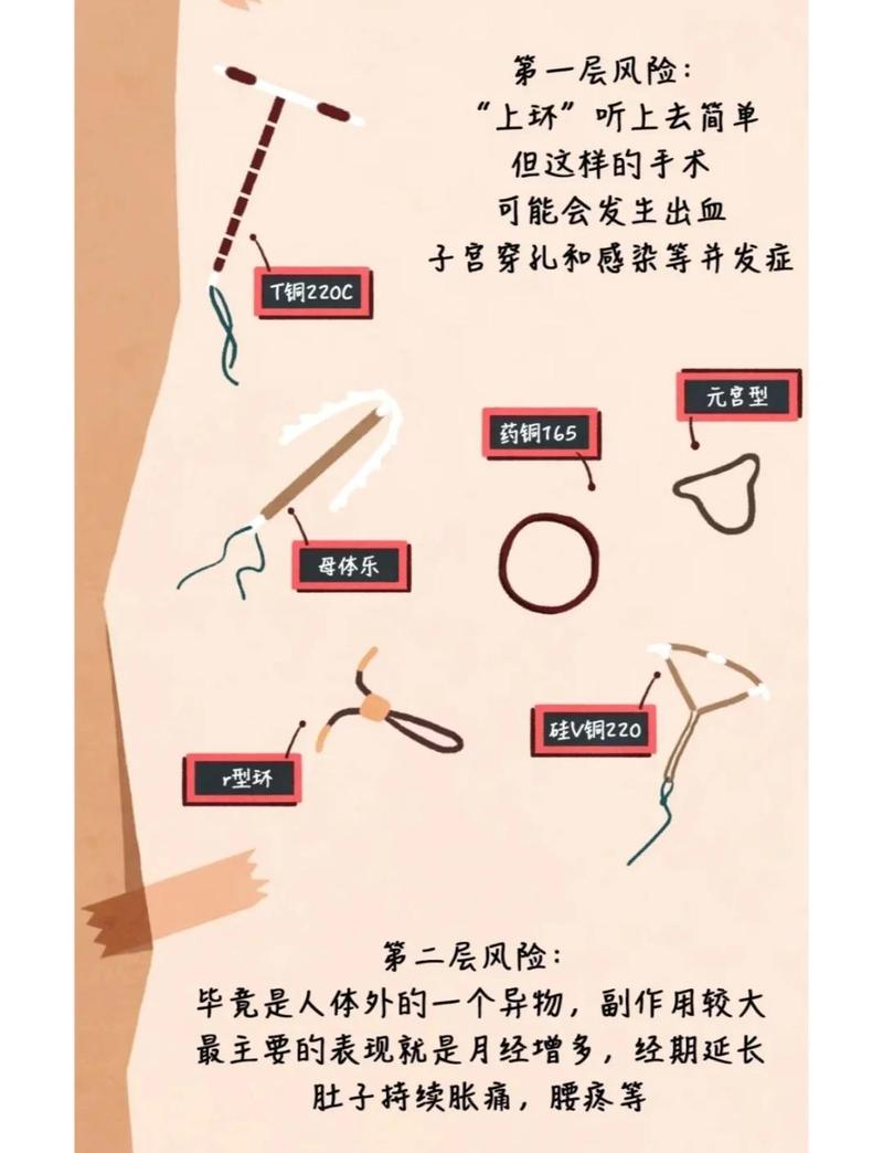 避孕环到期不取有什么风险-示意图