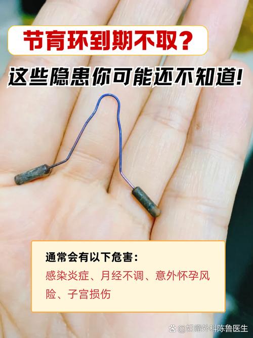 避孕环到期不取有什么风险-相关配图