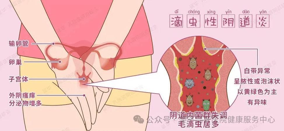 阴道毛滴虫感染怎么规范治疗-相关配图