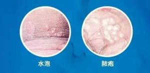 生殖器疱疹没症状时还会传染吗?一文说清无症状传播风险-两性知识丨两性健康--你想了解的我都知道