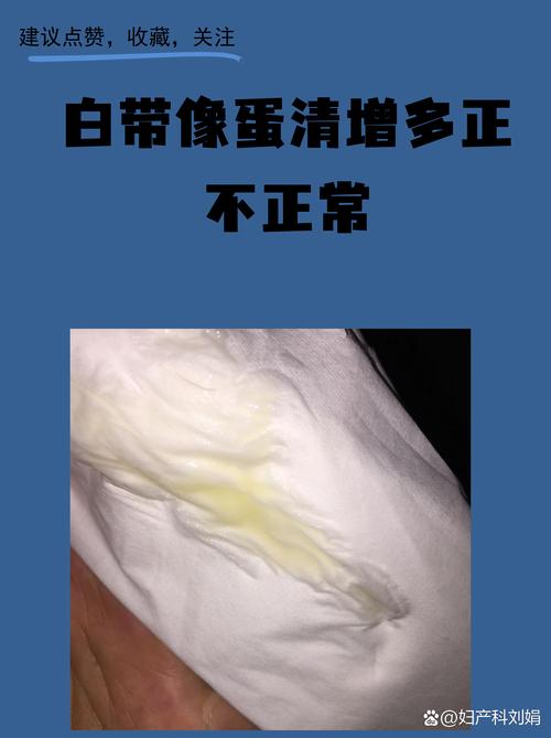 白带像蛋清一样拉丝代表什么-相关配图