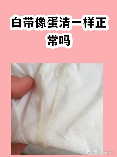 白带像蛋清一样拉丝代表什么-示意图