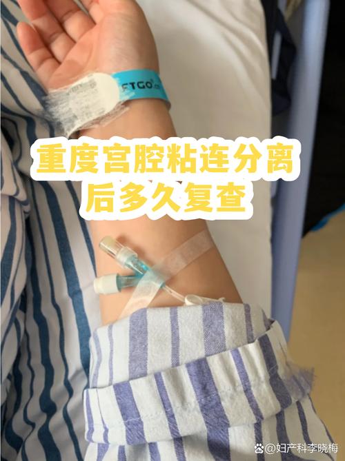 宫腔粘连分离术后多久复查