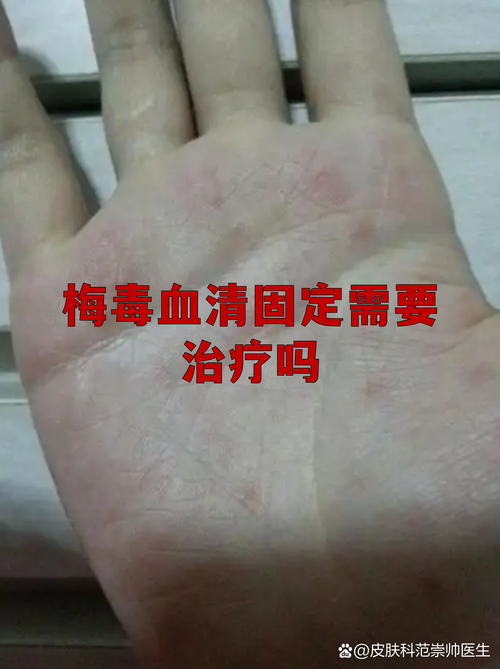 梅毒血清固定需要长期治疗吗