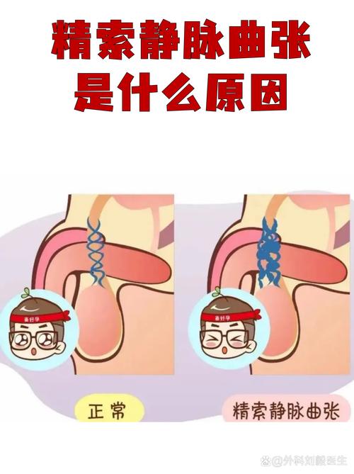 精索静脉曲张与碎片率有关吗