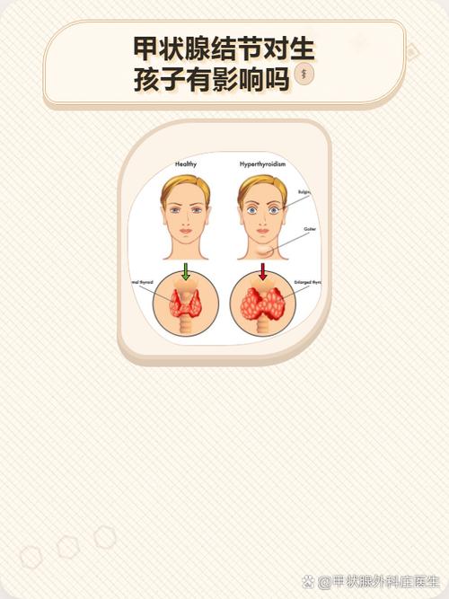 甲状腺结节和生育有关系吗