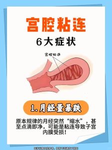 宫腔粘连有哪些症状?一文读懂身体发出的信号!-两性知识丨两性健康--你想了解的我都知道