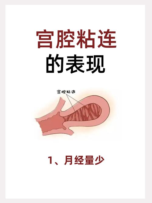 宫腔粘连有哪些症状