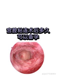宫腔粘连术后多久可以备孕?-两性知识丨两性健康--你想了解的我都知道