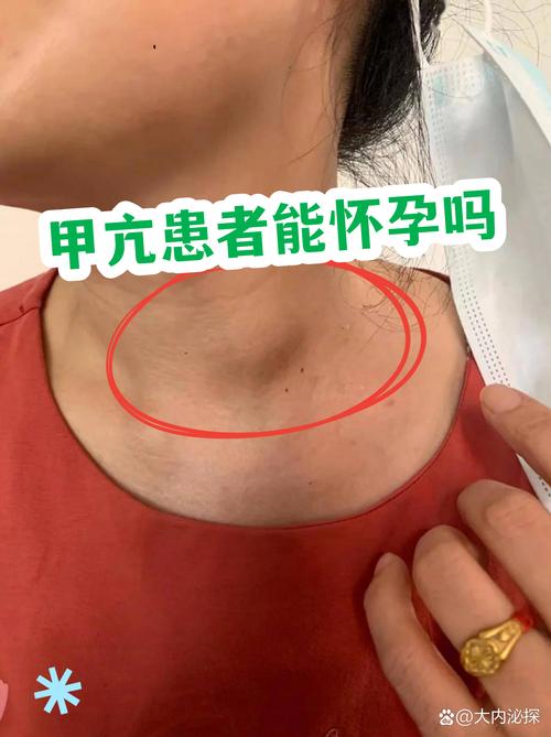 甲亢没控制好能怀孕吗