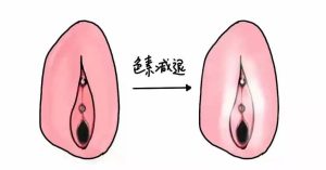 外阴白斑复查频率:稳定期3-6个月一次,有变化立刻去-两性知识丨两性健康--你想了解的我都知道