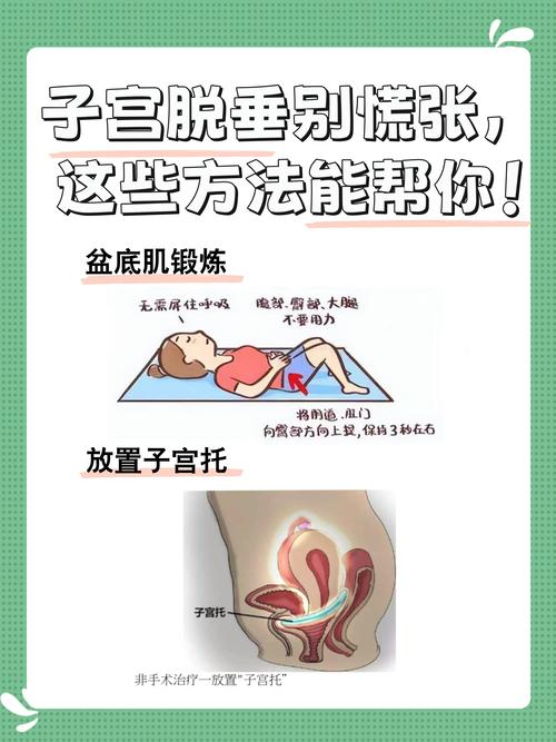 子宫脱垂轻度需要手术吗-相关配图