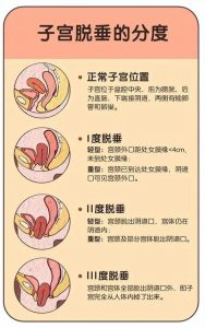 轻度子宫脱垂不用手术,盆底肌锻炼就能改善-两性知识丨两性健康--你想了解的我都知道
