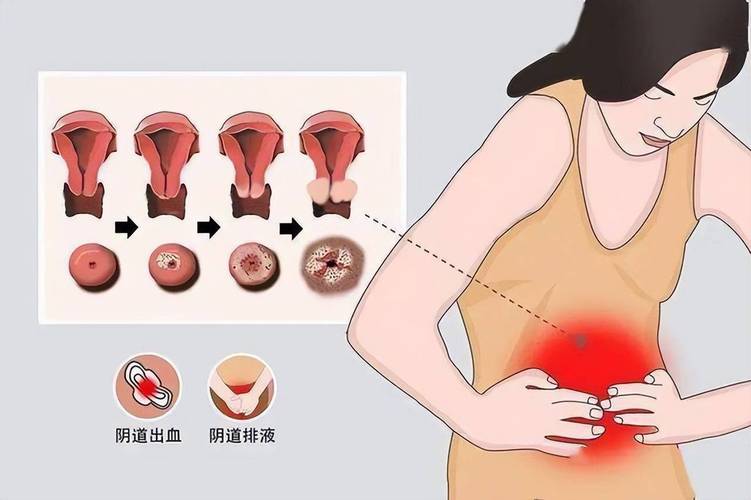 阴道排液带血丝要紧吗