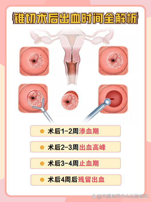 宫颈锥切后出血多久正常