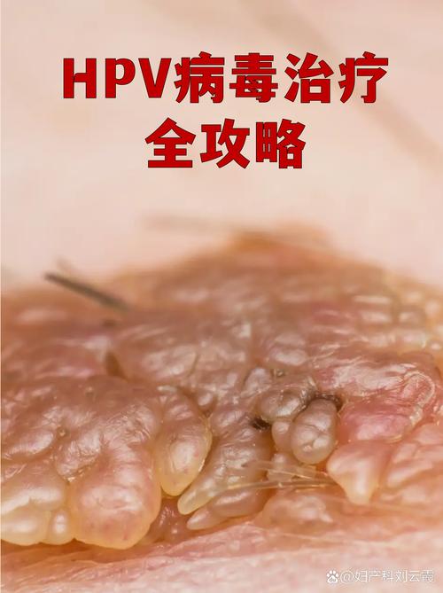 HPV感染过度治疗有哪些危害