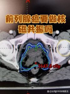 前列腺癌筛查一定要做核磁共振吗？-两性知识丨两性健康--你想了解的我都知道