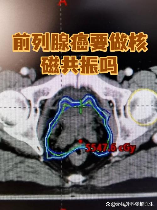 前列腺癌筛查要做核磁吗