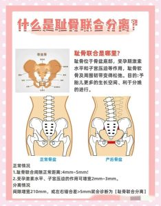 性欲低和产后耻骨联合分离有关吗?-两性知识丨两性健康--你想了解的我都知道