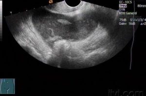 妇科B超查卵巢囊肿准确吗?一文读懂检查真相!-两性知识丨两性健康--你想了解的我都知道