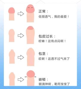 包皮过长什么情况需要手术?这几种情况别再犹豫了-两性知识丨两性健康--你想了解的我都知道
