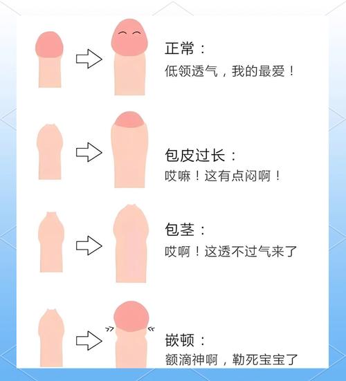 包皮过长什么情况需要手术