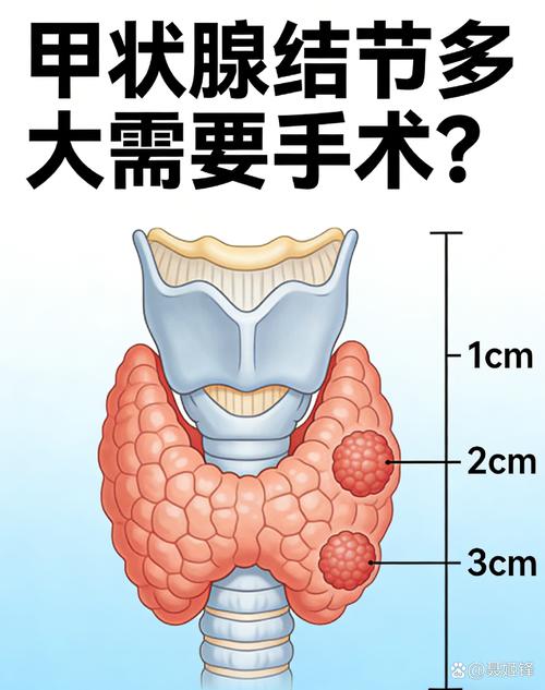 甲状腺结节需要手术吗