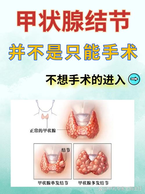 甲状腺结节需要手术吗
