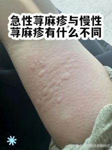 性欲低和慢性荨麻疹有关吗?一文说清背后联系!-两性知识丨两性健康--你想了解的我都知道