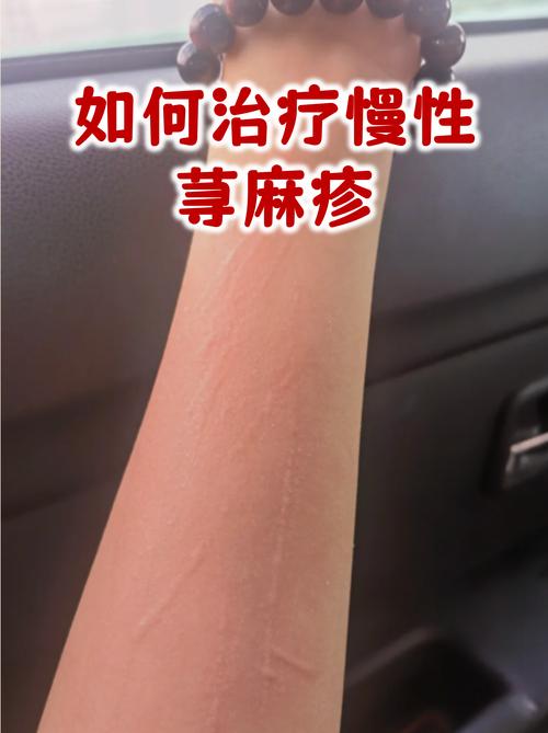性欲低和慢性荨麻疹有关吗