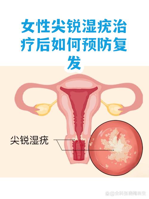 尖锐湿疣治疗后怎么防复发