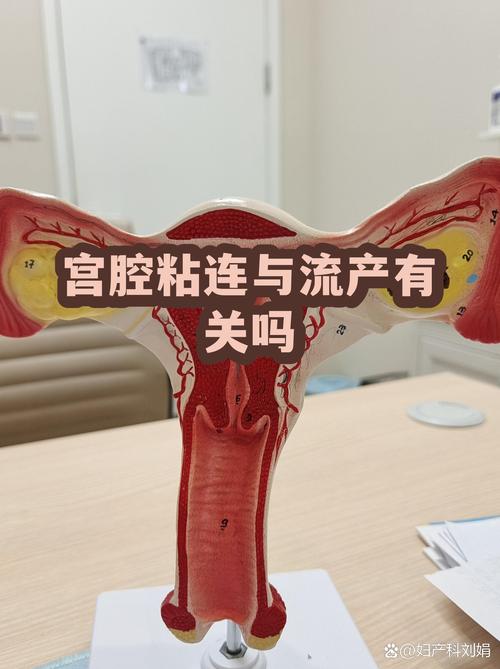宫腔粘连和反复流产有关吗