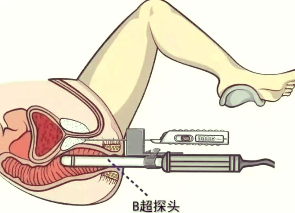 做前列腺穿刺是什么体验-相关配图
