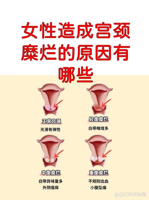 性欲低和宫颈糜烂误解有关吗