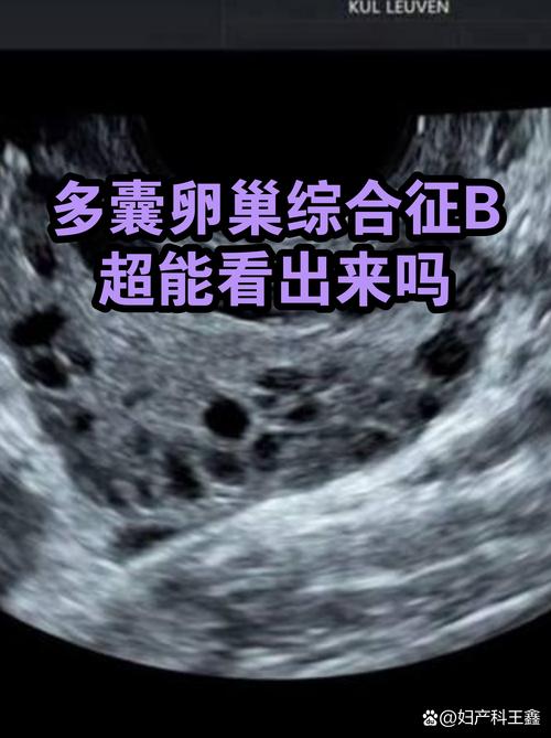 多囊诊断标准里超声怎么看