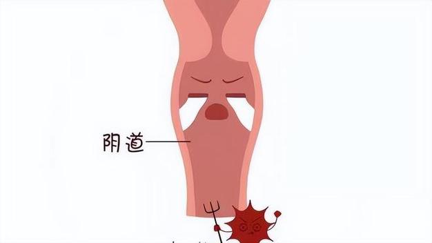 绝经后阴道干涩怎么改善