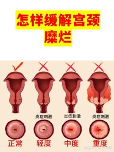 性欲低和宫颈病变有关吗?-两性知识丨两性健康--你想了解的我都知道
